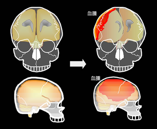 急性硬膜下血腫